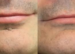 🔥 Curalona®2-in-1 Microneedle & Hydrocolloid Patch🔥| Removes Raised Moles, Acne, Flat Warts & Skin Tags | Helps Improve Wrinkles, Scars & Blemishes | Invisible Patches for Face & Body.