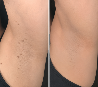 🔥 Curalona®2-in-1 Microneedle & Hydrocolloid Patch🔥| Removes Raised Moles, Acne, Flat Warts & Skin Tags | Helps Improve Wrinkles, Scars & Blemishes | Invisible Patches for Face & Body.