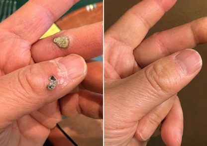🔥 Curalona®2-in-1 Microneedle & Hydrocolloid Patch🔥| Removes Raised Moles, Acne, Flat Warts & Skin Tags | Helps Improve Wrinkles, Scars & Blemishes | Invisible Patches for Face & Body.